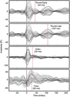 Case Study: Mapping Evoked Fields in Primary Motor and Sensory Areas via Magnetoencephalography in Tetraplegia